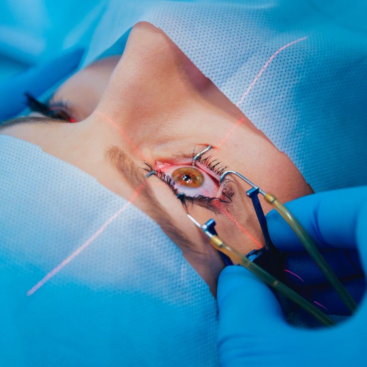 moins de dioptries ce qui compte dans le traitement des yeux au laser moins de dioptries ce qui compte dans le traitement des yeux au laser